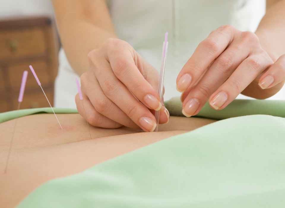 acupuncture-1